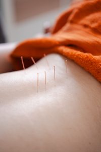 Dry needling Bideford